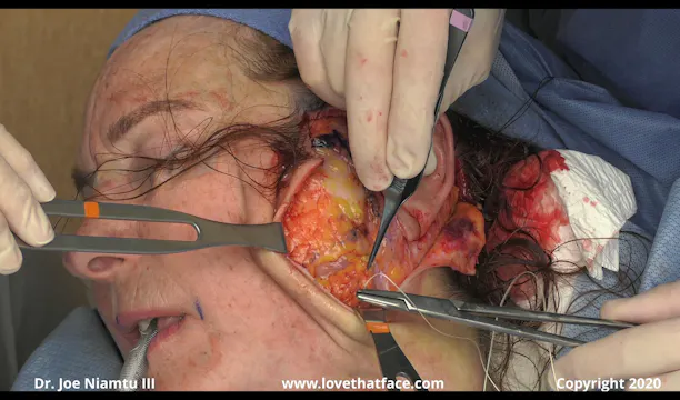 C SMASectomy with Cervical Extension Close Up