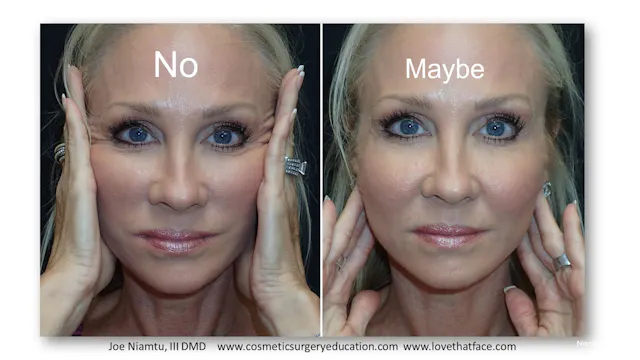 Platinum Minimally Invasive Facelift Lecture