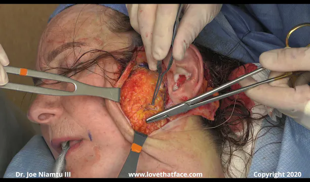 C SMasectomy with Cervical Extension Close Up