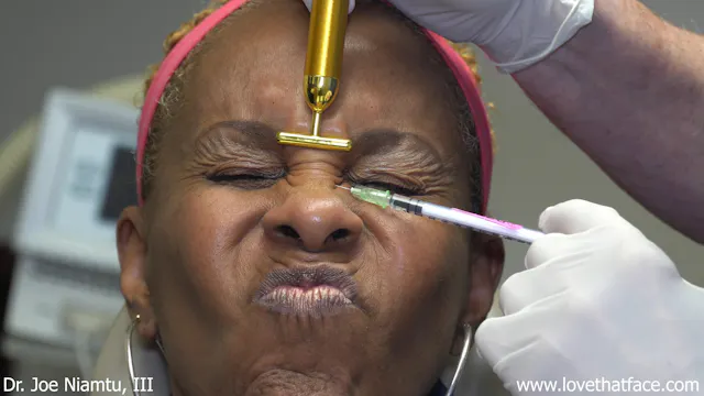 Botox to Bunny Lines and Lateral Canthus