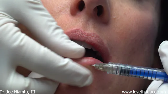 RHA Filler to LIps