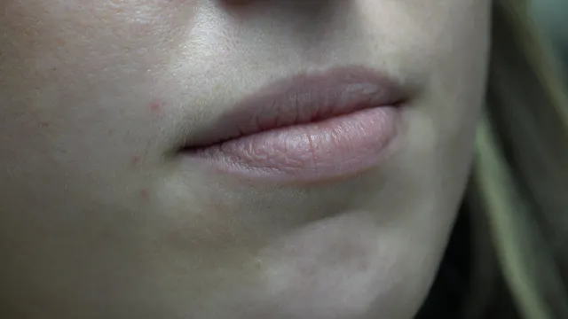 Botox "lip flip"