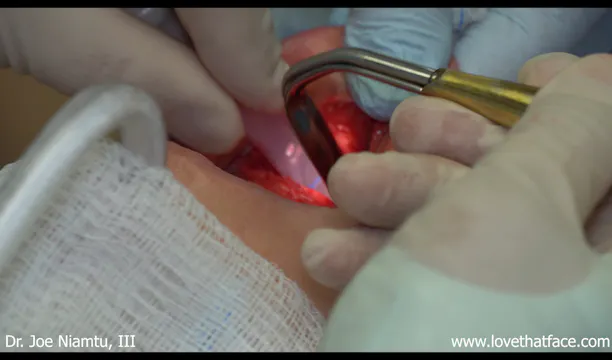 Intraoral Removal and Relacement of Silicone Chin Implant-Surgeon's View