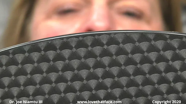 Juvederm Vollure to Nasolabial Folds and Perioral and Botox to 3 Areas