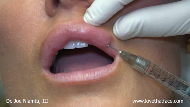 Juvederm Vollure to Lips