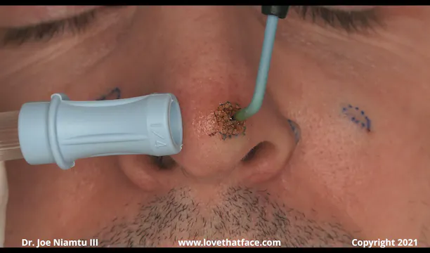 Nose and Cheek Mole Removal with Ellman System