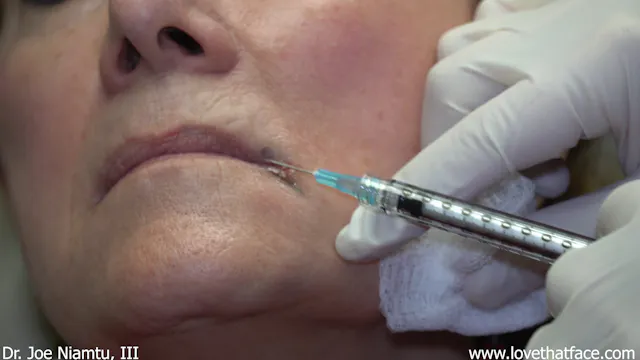 FIller Injection for Angular Chelitis of Oral Commissure