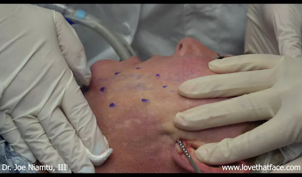 Jowl Liposuction Case 1