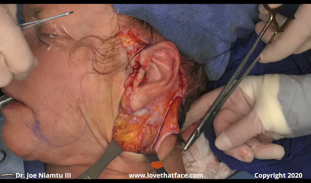 Intermediate and Advanced SMASectomy
