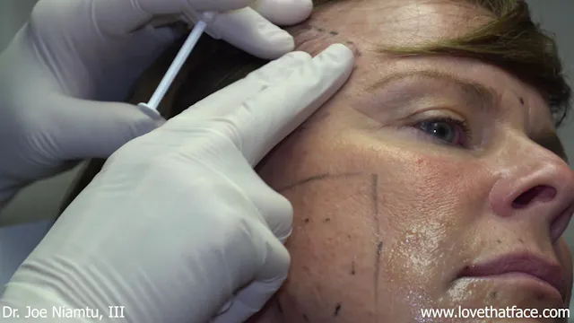 Botox to Blateral Masseter and Temporalis