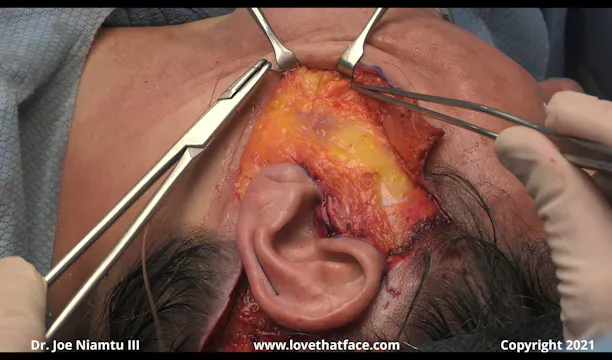 Identifying and Treating the Jowl