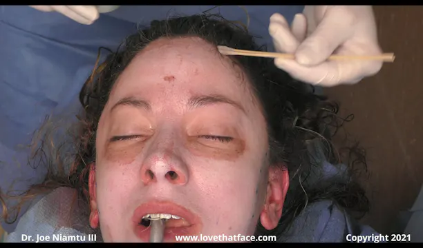 Full Cace 20% TCA Chemical Peel