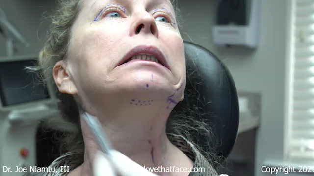 Facelift Marking Patient 1