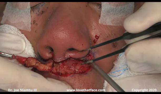 Subnasal Lip Lift Case 1