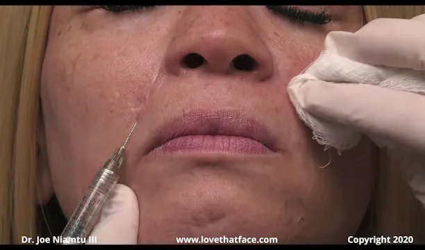Voluma to Nasolabial Folds with Needle