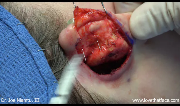 Case 3 Davis and Mustarde Opoplasty and 24 Hour Follow Up