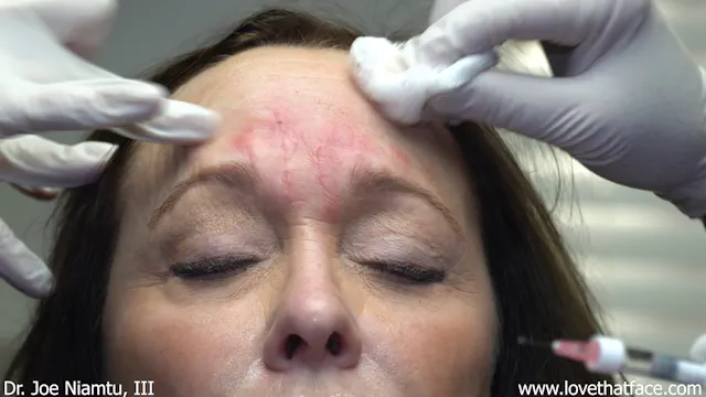 Restylane to Glabella Case 2