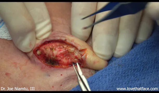 Case 1 Otoplasty with Mustarde Sutures and Mini Davis Cartilage Procedure