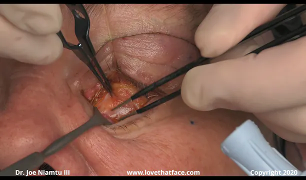 Multimodal Upper and Lower Blepharoplasty with Canthopexy