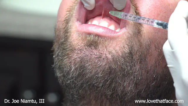 Silicone Filler to Lips