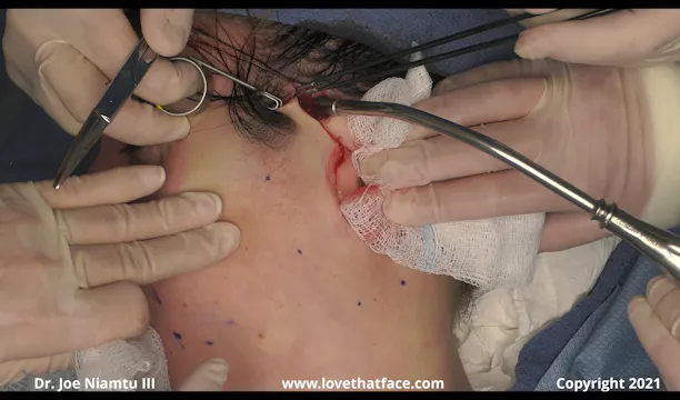 Weekend Short Scar Facelift with Minilift Conversion Case 2