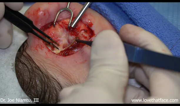 Case 4 Davis and Mustarde Otoplasty
