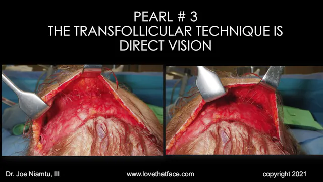 Platinum Transcutaneous Brow & Forehead Lecture