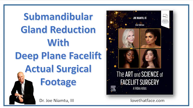 Submandibular Gland Reduction in Deep Plane Facelift