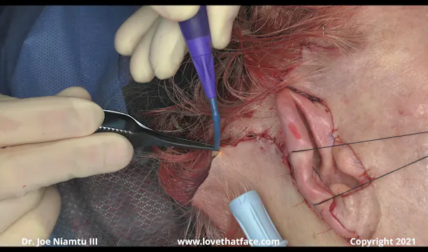Soniquence Sampler- Facelift and Blepharoplasty