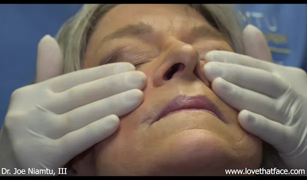 Two Methods of Cheek Filler Injection