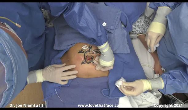 Fat Transfer from Abdomen to Face