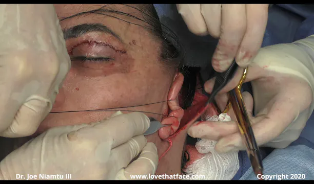 Facelift with Platys single side part 2 part 1 and 2 crackle