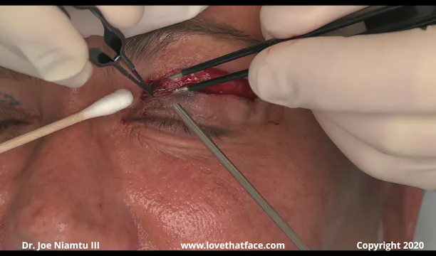 Upper Eyelid Revision Blepharoplaty