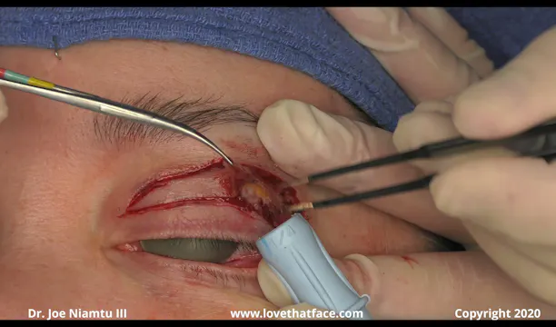Scalpel and Radiowave Upper and Lowere TC Blephaorplasty