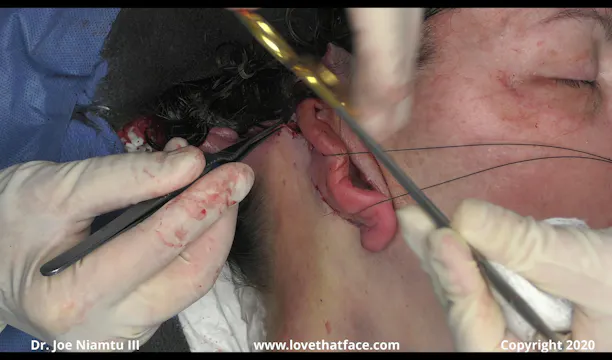 Great Posterior Key Sutures and Skin Excision