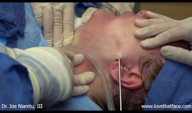 Submental and Jowl Liposuction