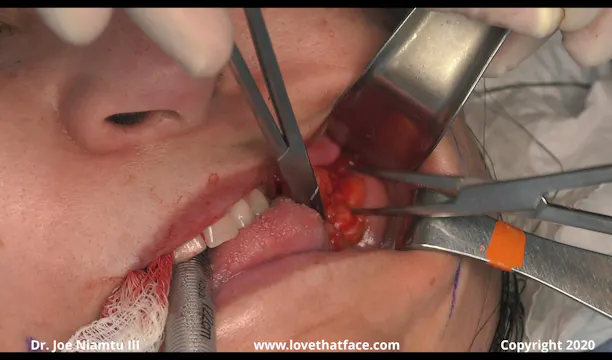 Buccal Fat Reduction Case 4