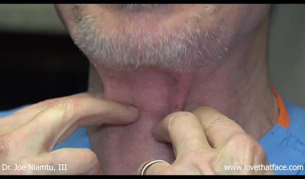 40 Units of Botox to Platysmal Bands