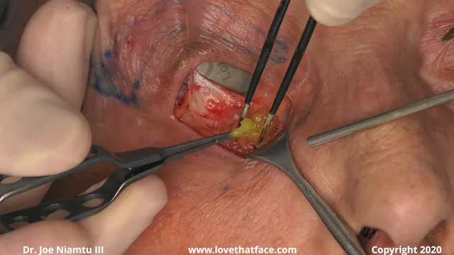 Upper and Lower Laseer Bleph with Canthopexy and CO2 Laser to Lower Lids