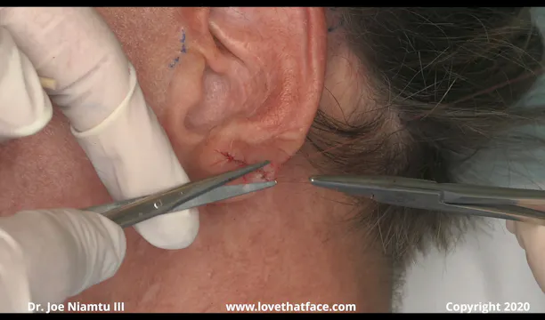 Earlobe Repair