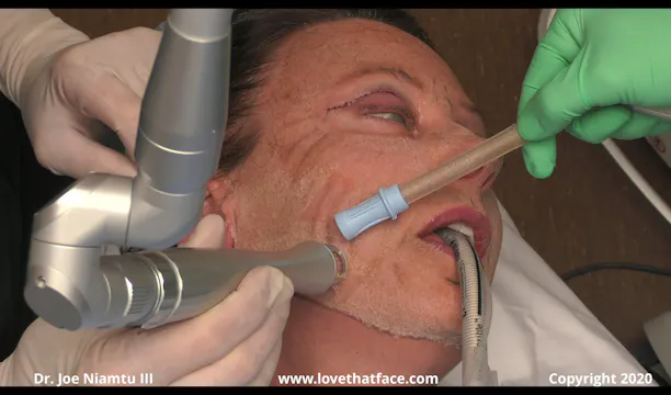 Case 4 Full Face Hybrid CO2 Laser Resurfacing