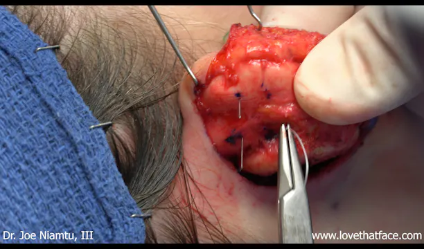 Case 3 Davis and Mustarde Opoplasty and 24 Hour Follow Up