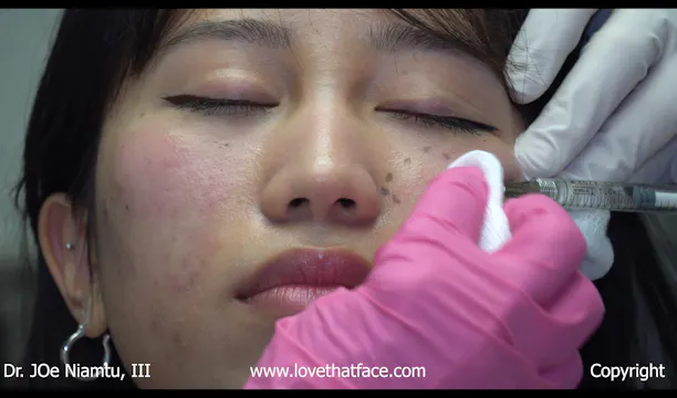 Restylane Cheek Filler on Asian Patiant