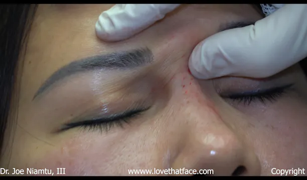 Filler Rhinoplasty