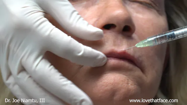 Volbella to Lip Lines, Outline and Plumping