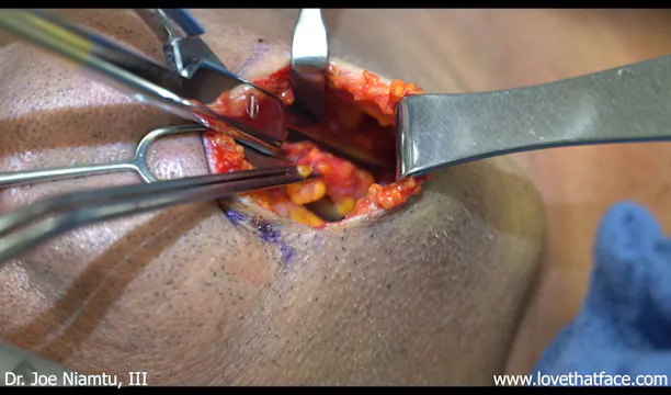 Close Up Great Male Platysmaplasty