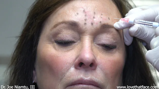 Restylane to Glabella Case 2