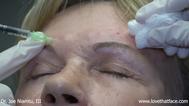 25 Units of Botox to glabella (2)