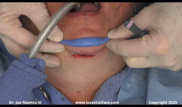 Mandibular Glove Implant with Submental Approach