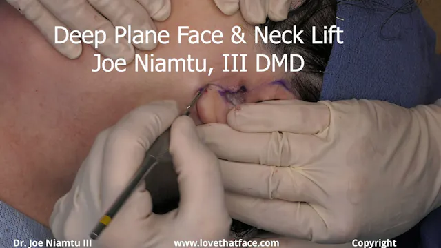 20. Deep Plane Dissection Single Side Long skin Flap